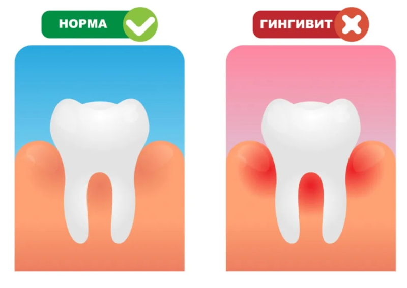 Гингивит