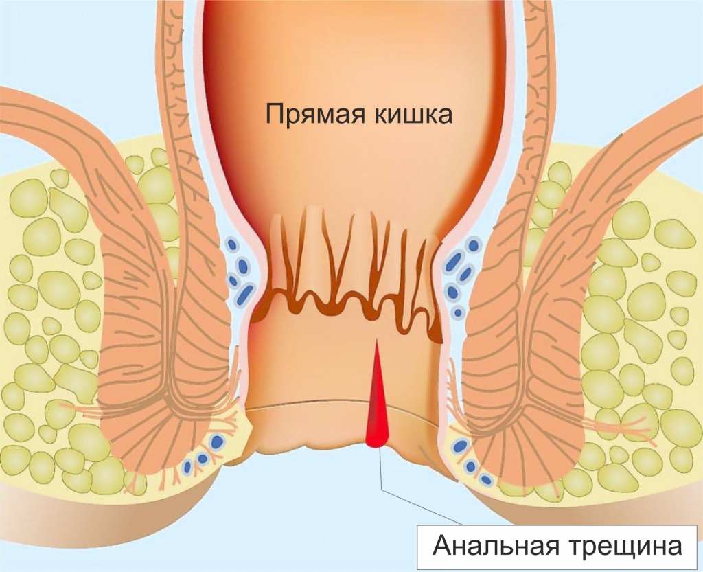 analnaya-treschina-1.jpg