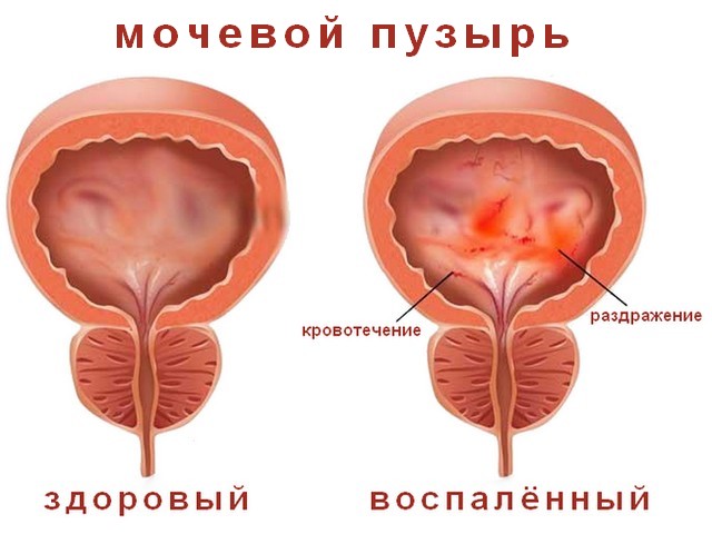  Хронический цистит 