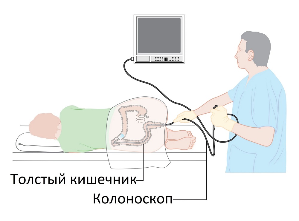 Язвенный колит 