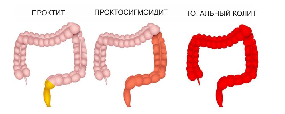 Язвенный колит 