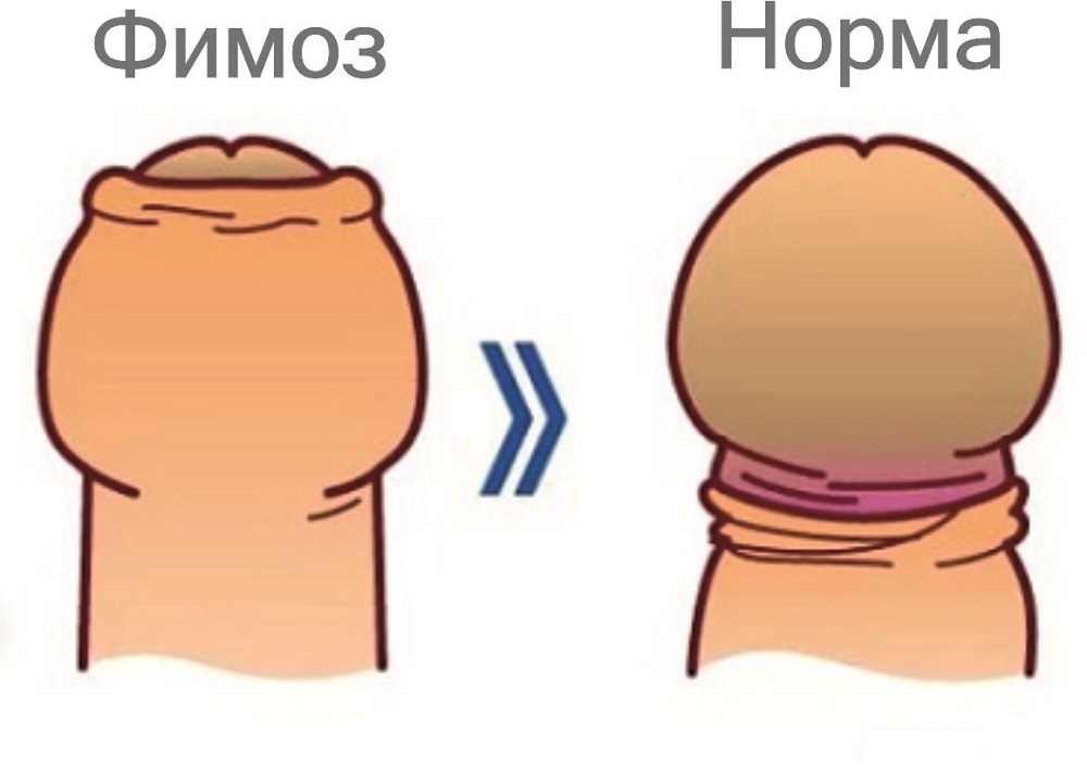  Фимоз 